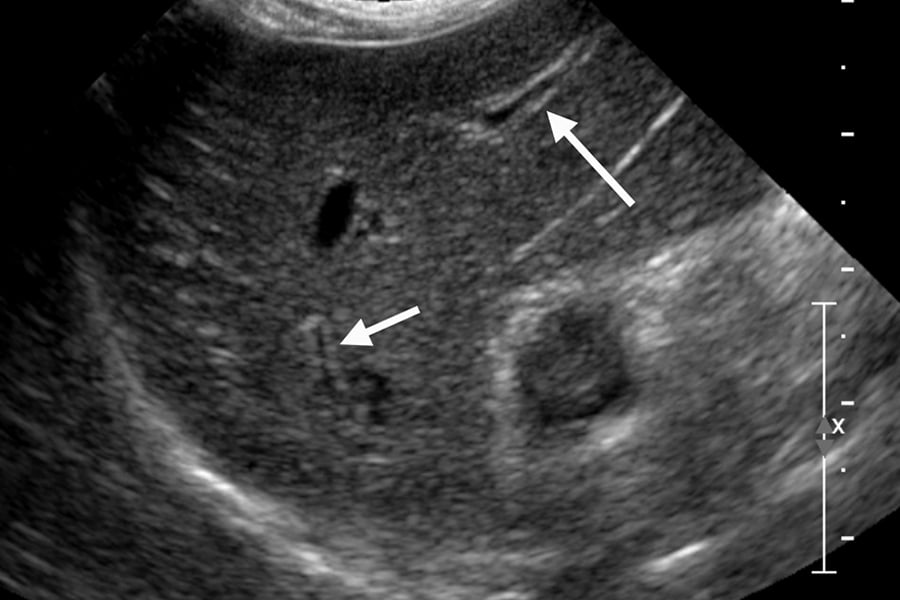 Ultrasound
